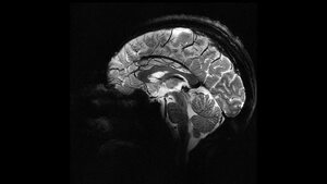 Image of: COVID‑19 Pandemic May Have Accelerated Brain Aging — Even Without Infection