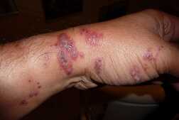 Image of: Bubonic Plague Resurfaces in Arizona in 2025: What You Need to Know