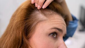 Image of: 3 Medical Causes Behind Sudden Hair Loss and Thinning, According to Dermatologists