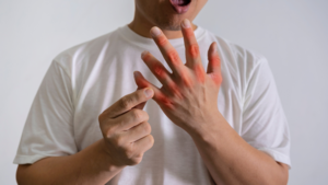 Image of: High Uric Acid: 5 Skin Symptoms to Watch For