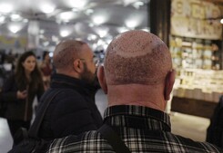 Image of: Why Balding Individuals Are Flocking to the Middle East for Hair Transplants