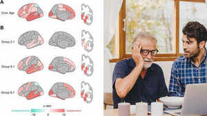 Image of: Brain Shape Changes: Early Indicators of Alzheimer's and Dementia